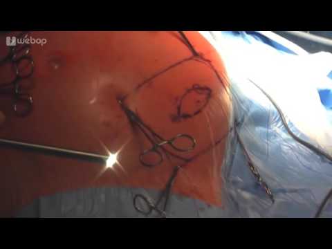 Wie Hüftdysplasie bei Säuglingen zu diagnostizieren Spondylose der Wirbelsäule Ladung