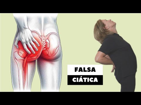FALSA CIÁTICA