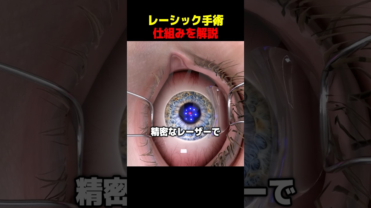 レーシック手術仕組みを解説