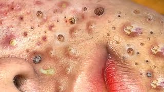 Loan Nguyen Acne Treatment 21n