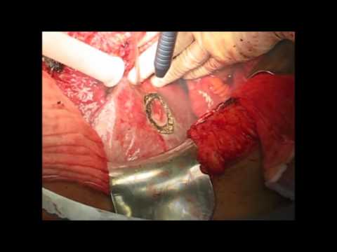 Limax® 120 – Liver surgery