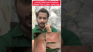 A Female Patient case of Melasma From 18 Years