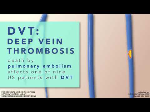 DVT Wearable Ultra-Sensor Patch