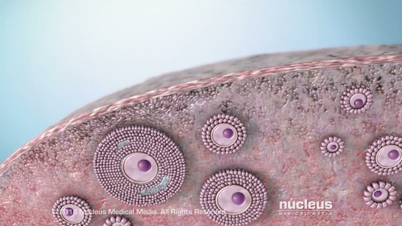 Understanding Ovarian Cancer