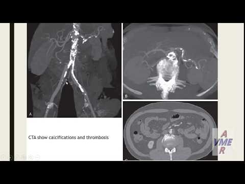 Atheromatous Embolization and Its Management