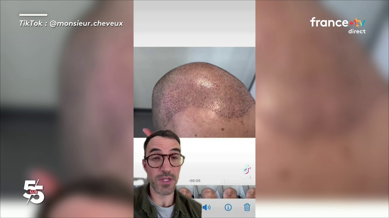 Calvitie : alerte sur un médicament très utilisé