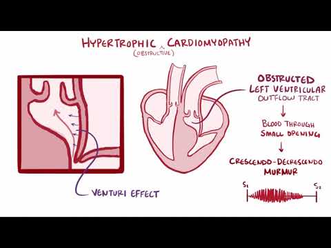 Hypertrophic cardiomyopathy HCM   causes, symptoms, treatment & pathology