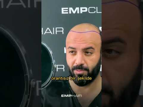 Ön saç çizgisinin belirlenmesi