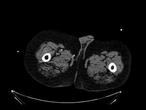 Aortoiliac Occlusive Disease  CT Coronal 1  Annotated  JETem 2021