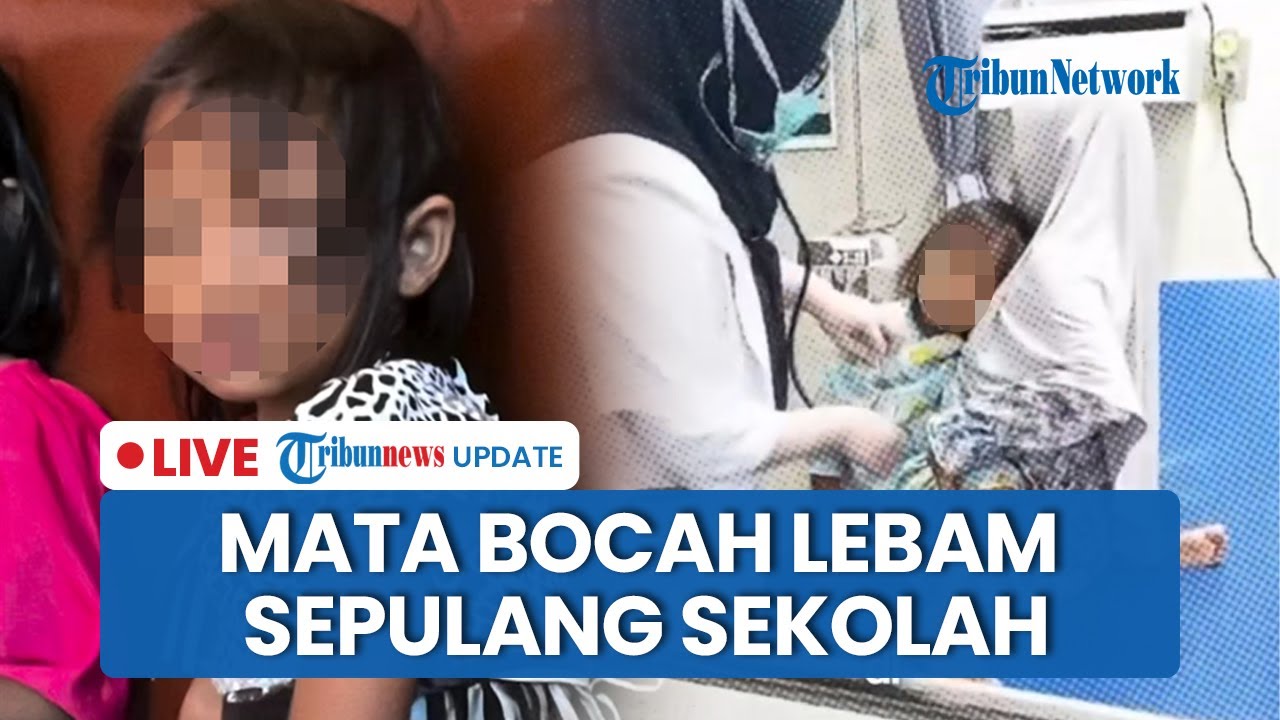 LIVE: Mata Bocah di Palembang Tiba-tiba Lebam, Ibu Lapor Polisi hingga Wali Kota Turun Tangan
