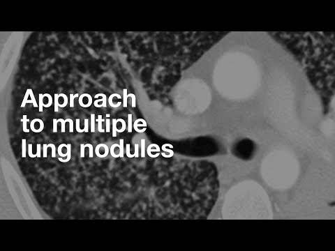 Algorithmic Approach to Multiple Lung Nodules