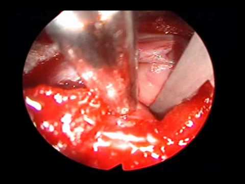 Cushing Syndrome - Sphenoid Ostium Access