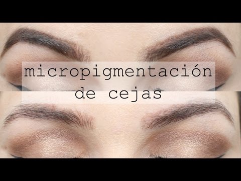 Prezzemolo da posti di pigmentary che svegliano tutti a dobra Eliminazioni di pigmentazione su una faccia le risposte laser