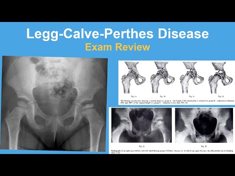 Legg-Calve-Perthes Disease Coxa Plana Exam Review - Rachel Goldstein, MD