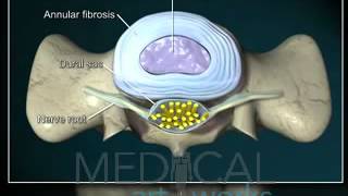 Hernia de disco - Dr. Francisco Javier López González