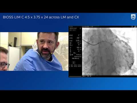 Complex PCI in distal LM stenosis
