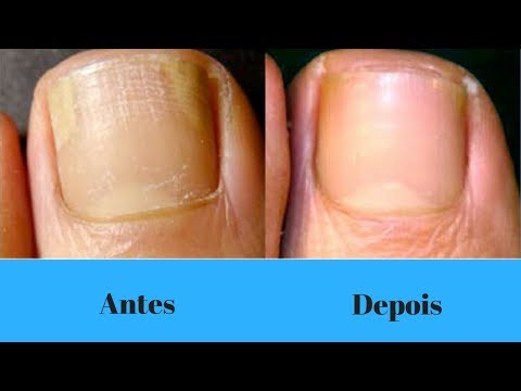Como eliminar micose das Unhas