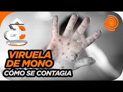 Video: La viruela de mono en Argentina: qué es y por qué la alerta