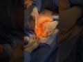 Transgender TOP Surgery Before And After With Amazing Results