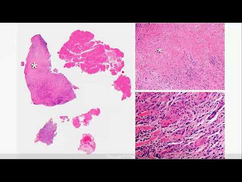 Ss13 Unusual Case of LV Mass Freemedbooks.com