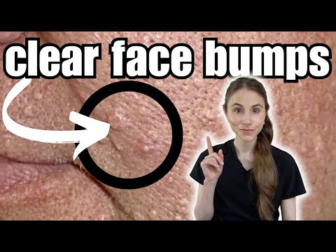 How To Clear And Prevent Face Bumps | Sebaceous Hyperplasia