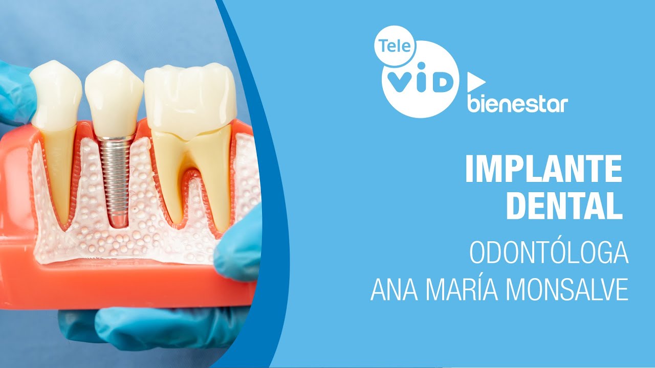 🏥💉Vuelve a sonreír sin miedo: así funciona un implante dental