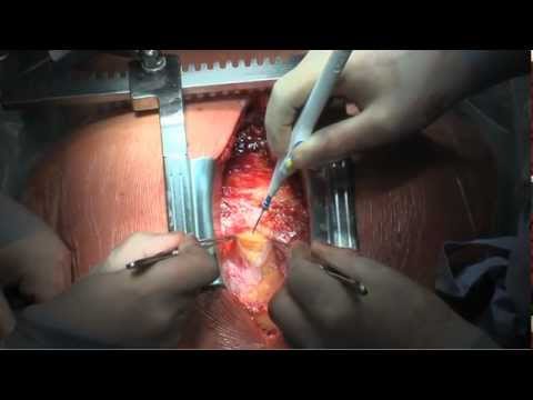 Educational video: open heart surgery, aortic valves reconstruction 