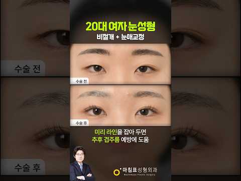 20대 여성의 졸린 눈 개선 · Korean