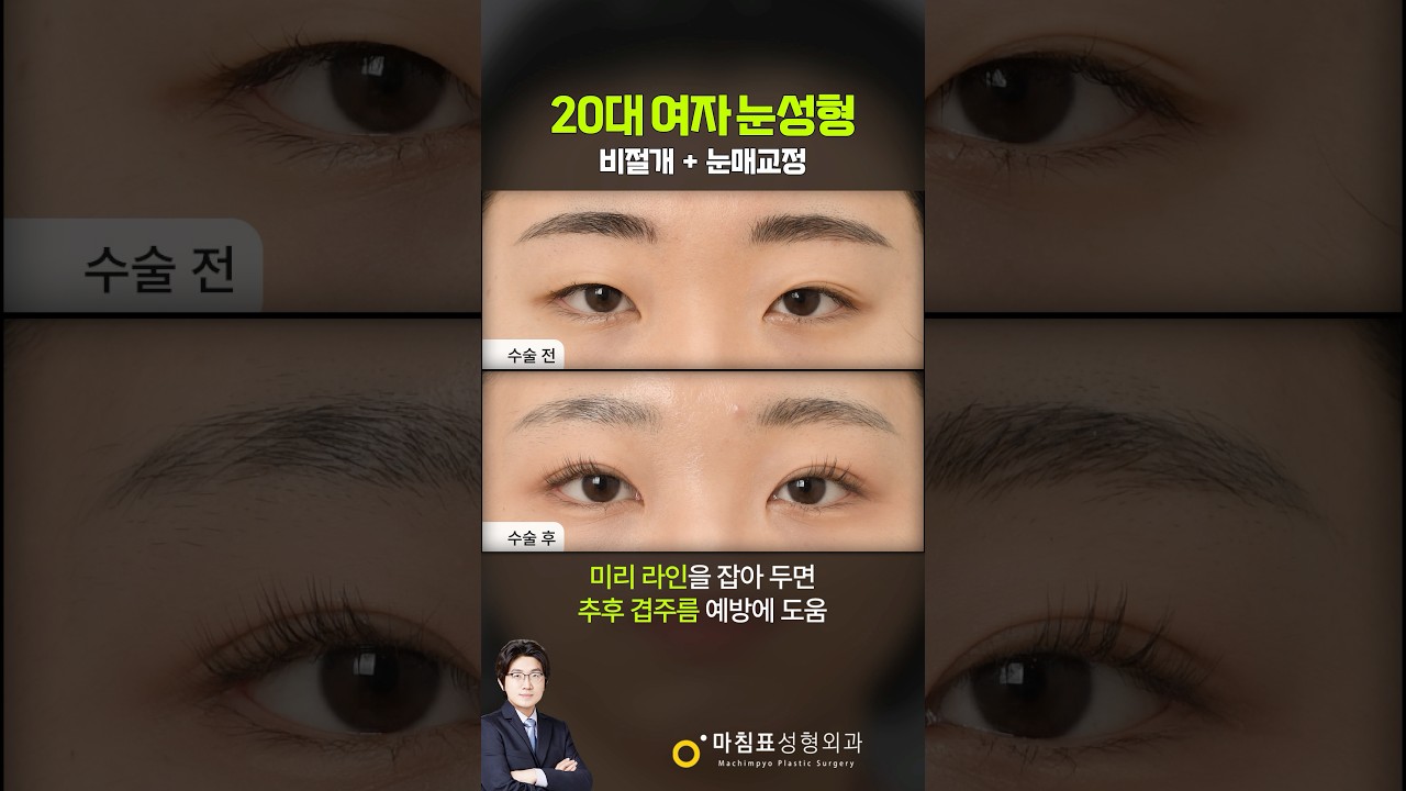 20대 여성의 졸린 눈 개선 썸네일 — 마침표성형외과 눈성형 영상