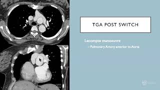 Aortic surgery in adult congenital heart disease – Dr Marco Larobina