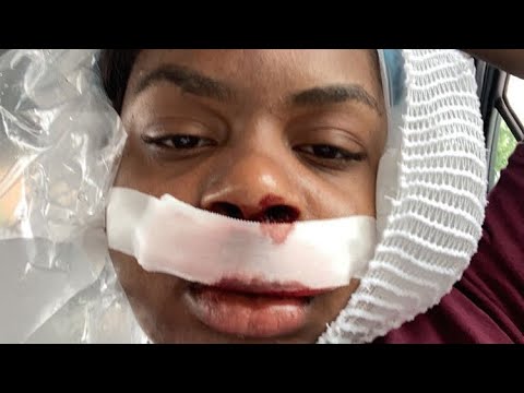 Why my Jaw got Broken (Bloody) SARPE Surgery & Wisdom Teeth removal