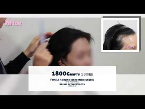 Female hairline correction surgery results after 12month - 뉴헤어 I 모발이식 I Before and After I