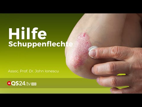 Die Behandlung des professionellen Ekzems auf den Händen Moknuschtschaja das Ekzem auf dem Hals des Fotos