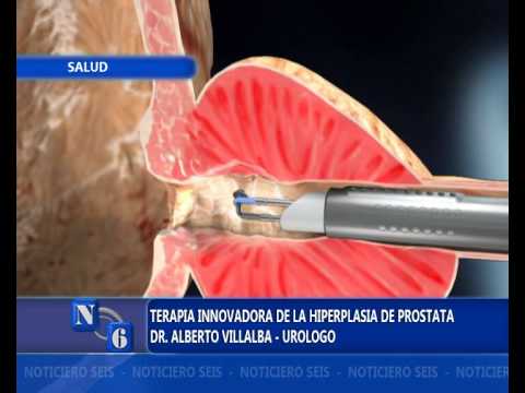 Come si ottiene la prostata Acqua morta e prostatite