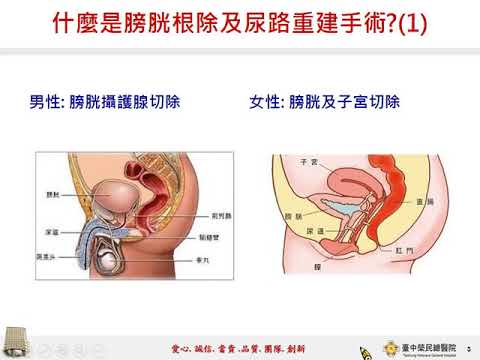 認識膀胱根除手術與尿道重建(王賢祥醫師)