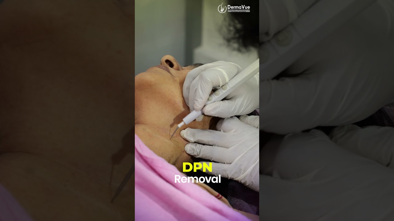 Those Tiny Dark Spots on Your Face Aren't Permanent — DPN Removal in Kerala#skintags