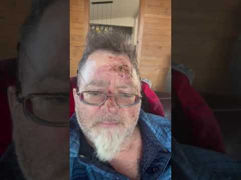 Lue Elizondo bike crash recovery diary 1