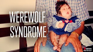 Living with ‘Werewolf Syndrome’ | Sunday Night Archive