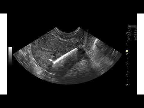 DIU penetrando o miométrio. Achados da ultrassonografia transvaginal.