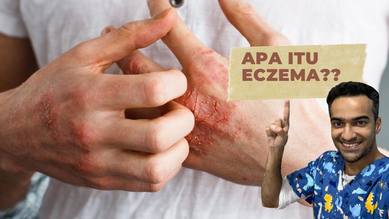 ECZEMA TIPS : JOM TONTON (2021)