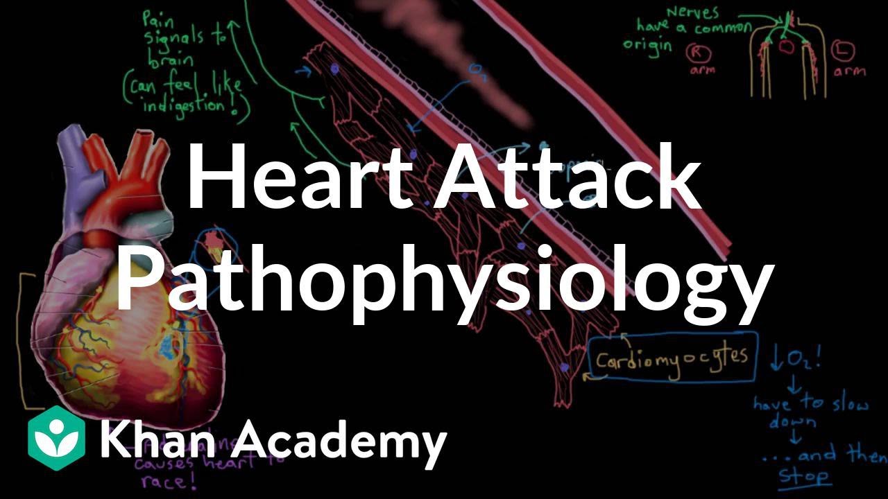 Heart attack (myocardial infarction) pathophysiology | NCLEX-RN | Khan Academy