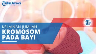Sindrom Edwards, Kelainan Jumlah Kromosom yang Menyebabkan Kelainan di Banyak Organ Tubuh Bayi
