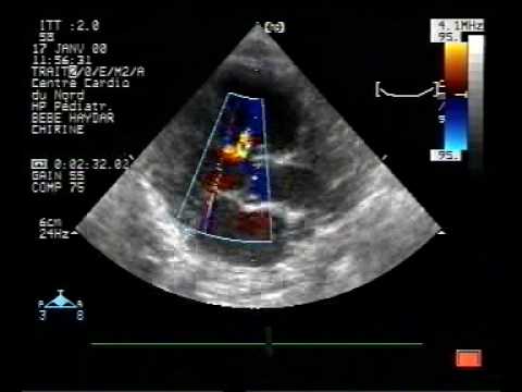  Ostium Secundum Vorhofseptumdefekt und muskulärer ventrikulärer Septumdefekt bei demselben Patienten