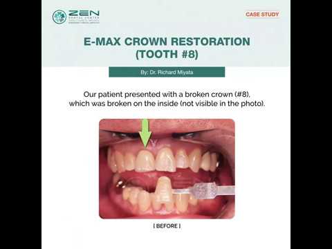 [Zen Dental] Case Study: E-MAX Crown Restoration (Tooth #8)