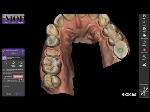CEREC with  exocad: how to get good fits