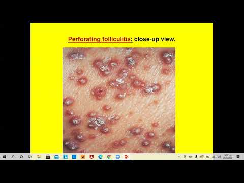 Lecture-64: Dermatopathology; Perforating dermatoses