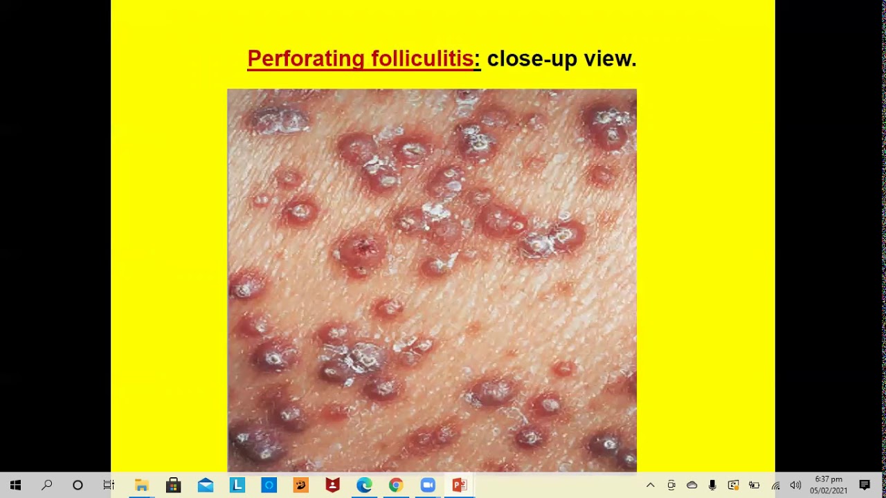 Lecture-64: Dermatopathology; Perforating dermatoses - YouTube
