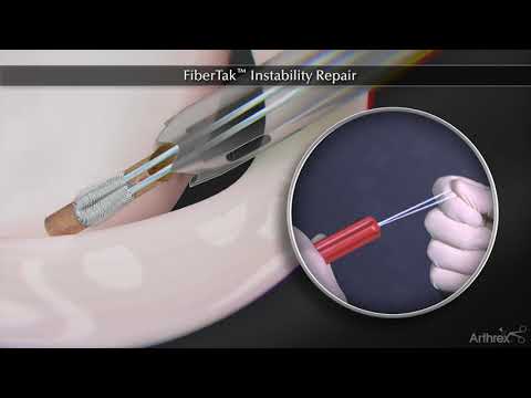 FiberTak Instability Repair