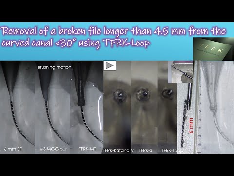 Removal of a broken file longer than 4.5 mm using TFRK-Loop/ループを使った4.5mm以上の破折器具の除去