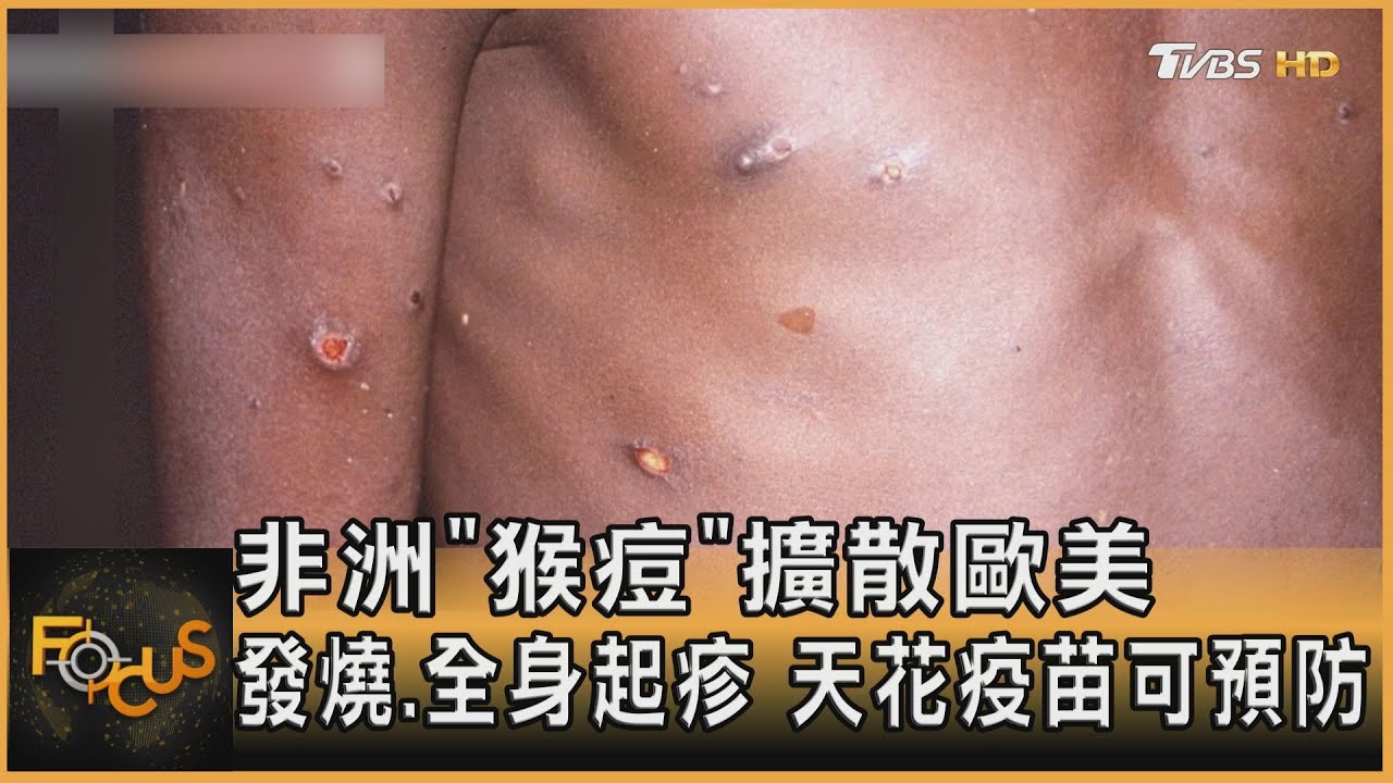 非洲「猴痘」擴散歐美 發燒.全身起疹.天花疫苗可防